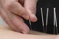 Agopuntura e Dry Needling